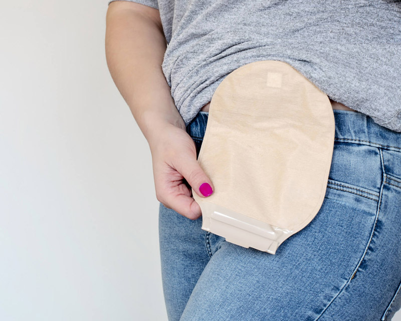 Stoma Care & Patient Support
